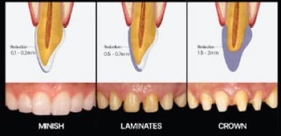 MINISH vs Laminates vs Crown - tooth reduction comparison showing MINISH requires only 0-0.2mm, laminates 0.5-0.7mm, and crowns 1.5-2mm